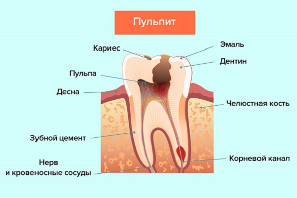 Что такое пульпит