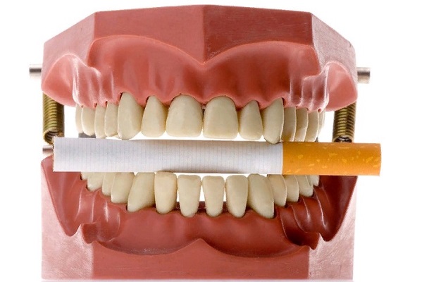 Имплантация зубов при курении