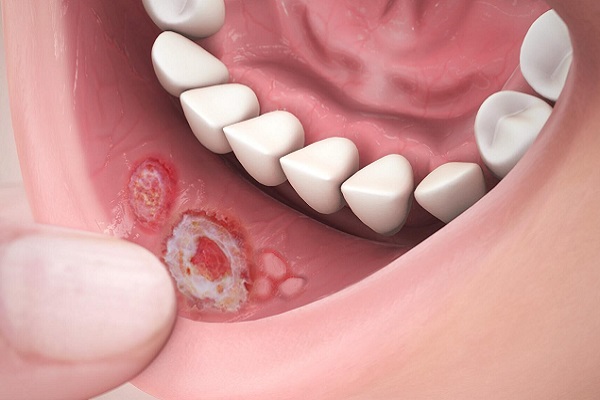 Как правильно лечить стоматит