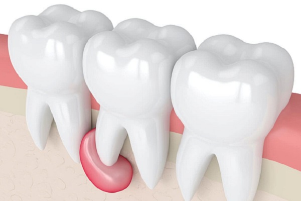 Киста на зубе - лечить или удалить