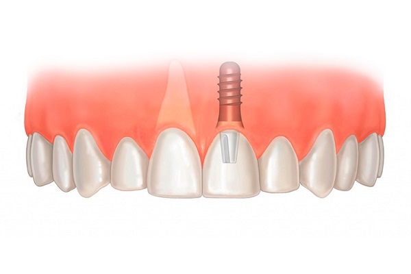 Способы восстановления передних зубов