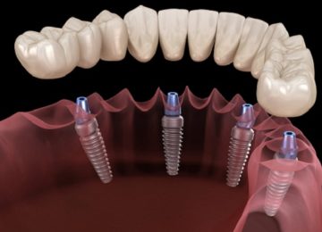 Имплантация All-on-4 в Калининграде