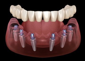 Имплантация All-on-6 в Калининграде