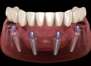 Имплантация зубов в Калининграде