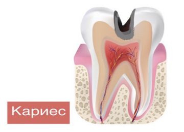 Диагностика и лечение кариеса в Калининграде