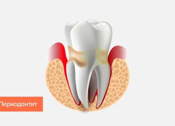 Лечение периодонтита в Калининграде