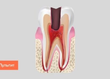 Лечение пульпита в Калининграде
