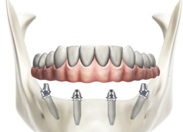 Пример протеза из зуботехнической лаборатории