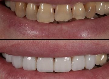 Этетическая реставрация зубов в Калининграде