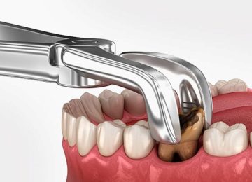 Удаление зубов в Калининграде