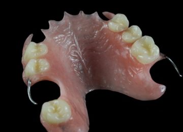 Изготовление и установка частичного съемного протеза в Калининграде