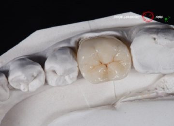 Изготовление м установка циркониевых коронок в Калининграде