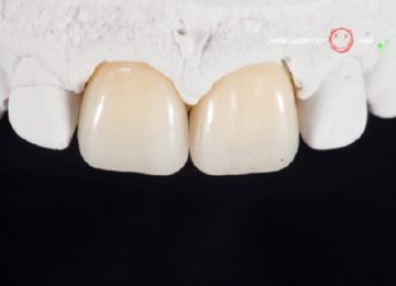 Изготовление и установка керамических коронок в Калининграде