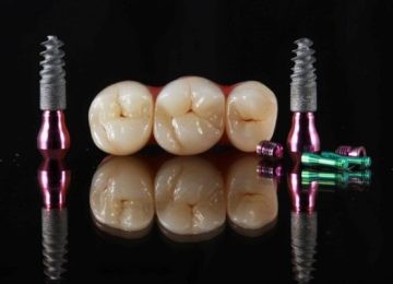 Изготовление и установка несъемных протезов в Калининграде