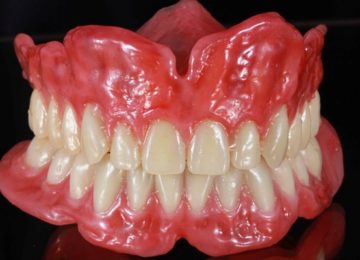 Изготовление и установка полного съемного протеза в Калининграде