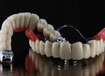 Изготовление и установка съемных протезов в Калининграде