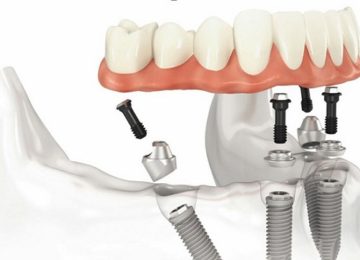 Изготовление и установка условно-съемного протеза в Калининграде