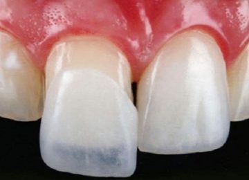 Изготовление и установка виниров в Калининграде