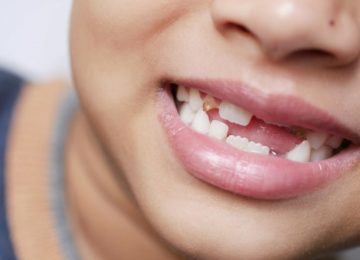 Детская стоматология: Уход за молочными зубами и детский кариес