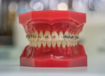 Исправить неправильный прикус - брекеты